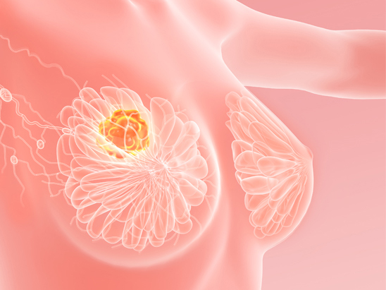 Tips to reduce the risk of Breast Cancer